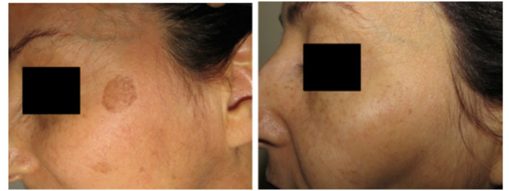 Spot Removal in Miami Florida by Fox Vein and Laser Experts.